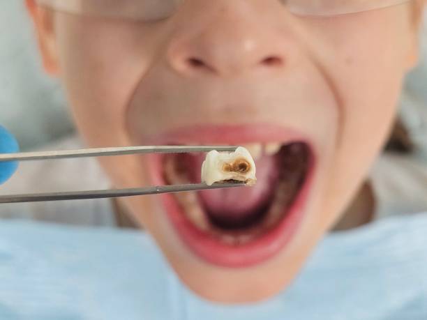 Best Knocked-Out Tooth (Avulsed Tooth) Treatment in Huntington Station, NY